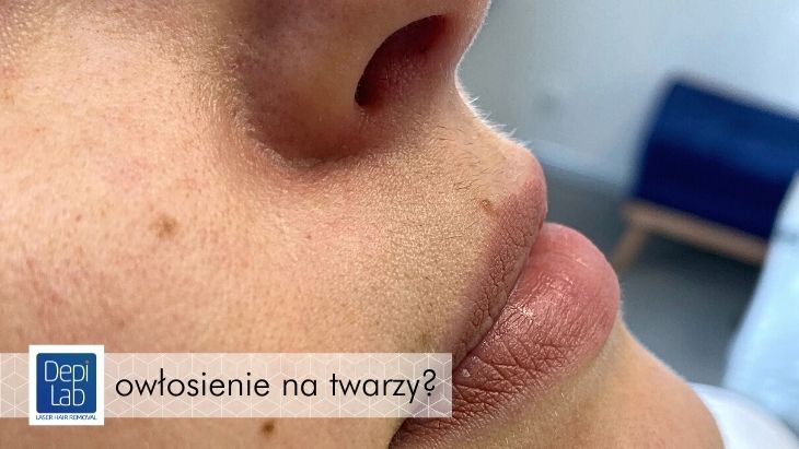Jak usunąć włoski z twarzy kobiety?