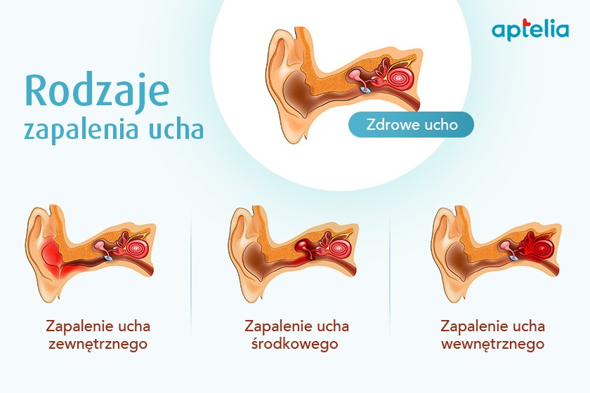 Co zwiastuje zapalenie ucha?