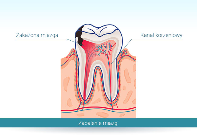 Gdzie promieniuje ból zęba?