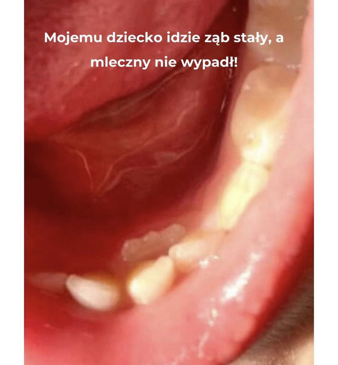Co zrobić z pierwszym mleczakiem?