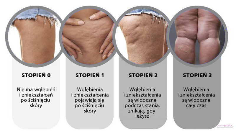 Czy da się pozbyc cellulitu w miesiac?
