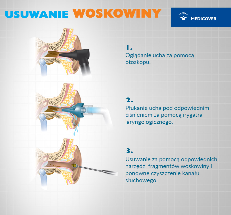 Jak wyczyścić uszy sposobem domowym?
