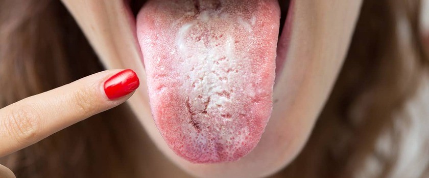 O czym świadczy nalot na języku?