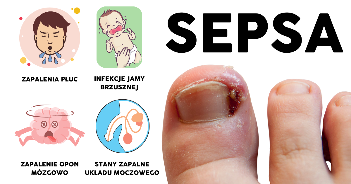 Czy antybiotyk chroni przed sepsą?