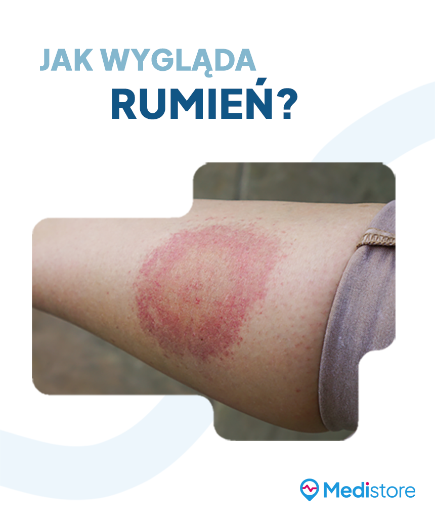 Z czym może być mylona borelioza?
